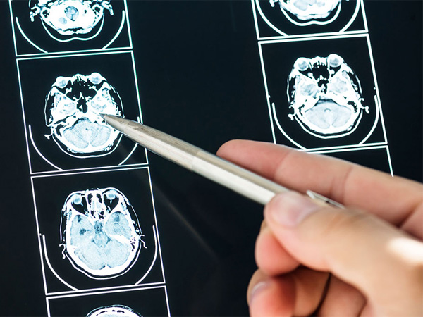 brain injury lawyer